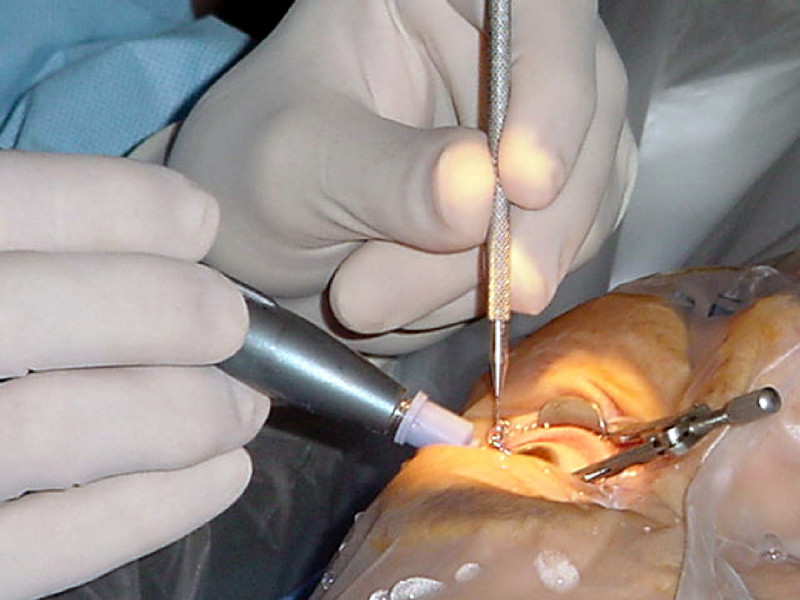 Cataract_surgery 030620-N-0000L-001
Portsmouth, Va. (Jun. 20, 2003) -- Cmdr. Gary A. Tanner, an ophthamologic surgeon at Naval Medical Center Portsmouth, inserts a synthetic lens into the eye of a patient following the removal of cataracts in her left eye. Cataract removal surgery is just one of the services offered at Naval Medical Center Portsmouth. U.S. Navy photo by Journalist 2nd Class Sarah Langdon. (RELEASED)